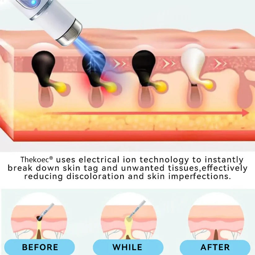 Thekoec® Medical-Grade Laser Pen 🌏 (Powered by CO₂ laser technology – effectively removes moles, warts, skin tags, pigmentation spots, and other skin imperfections)🔥