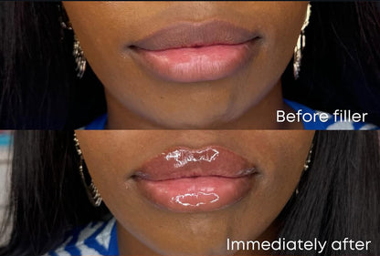Plumping Lip filler