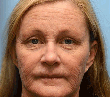 Botulin Bee Poison Wrinkle Removal Cream