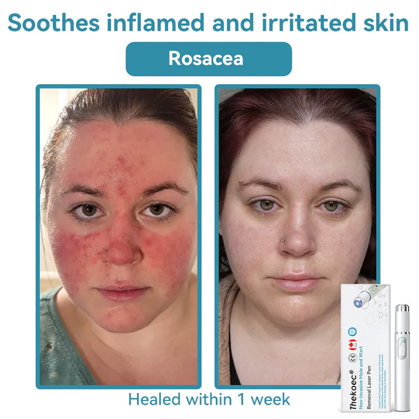 Thekoec® Medical-Grade Laser Pen 🌏 (Powered by CO₂ laser technology – effectively removes moles, warts, skin tags, pigmentation spots, and other skin imperfections)🔥