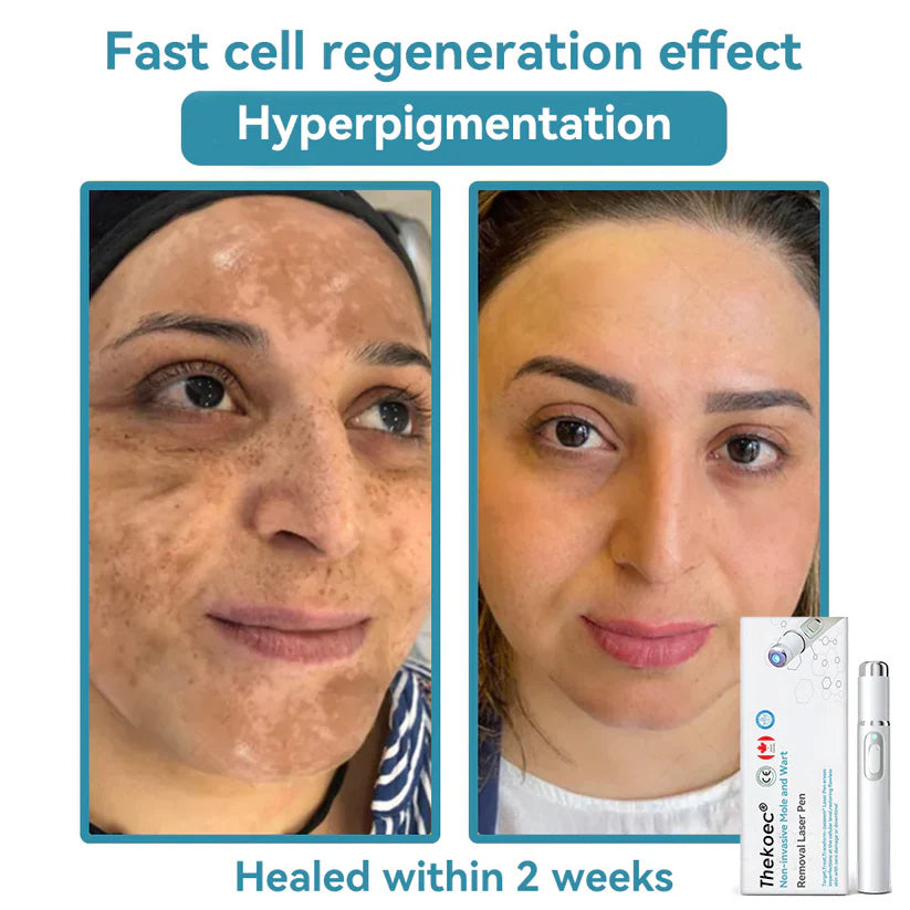 Thekoec® Medical-Grade Laser Pen 🌏 (Powered by CO₂ laser technology – effectively removes moles, warts, skin tags, pigmentation spots, and other skin imperfections)🔥