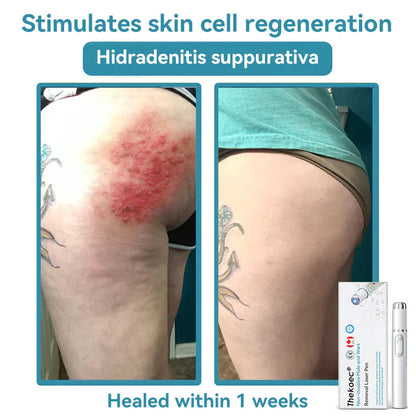 Thekoec® Medical-Grade Laser Pen 🌏 (Powered by CO₂ laser technology – effectively removes moles, warts, skin tags, pigmentation spots, and other skin imperfections)🔥