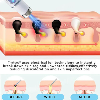 Thekoec® Medical-Grade Laser Pen 🌏 (Powered by CO₂ laser technology – effectively removes moles, warts, skin tags, pigmentation spots, and other skin imperfections)🔥