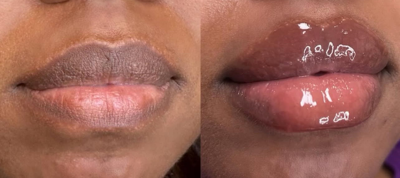 Plumping Lip filler
