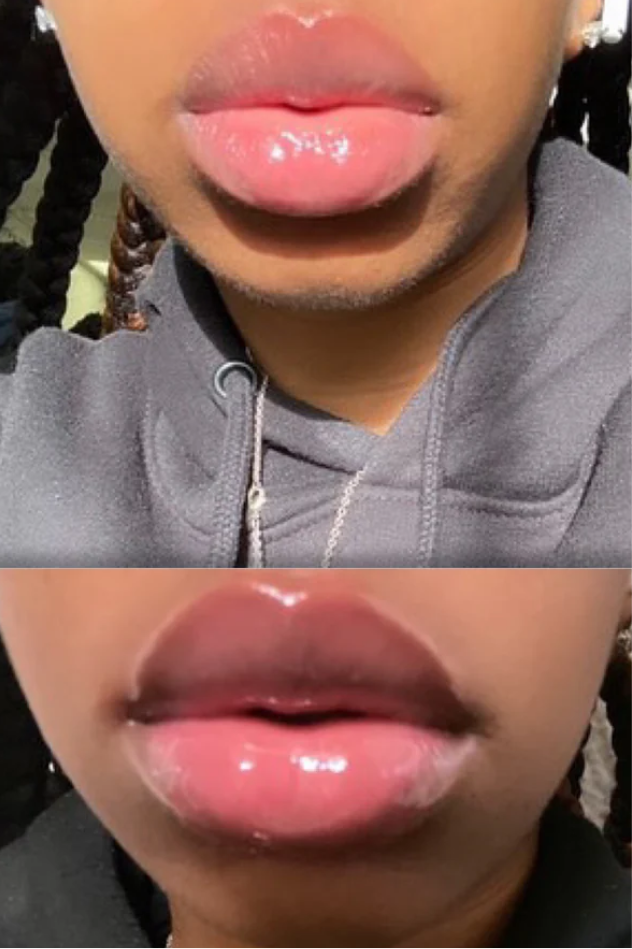 Plumping Lip filler