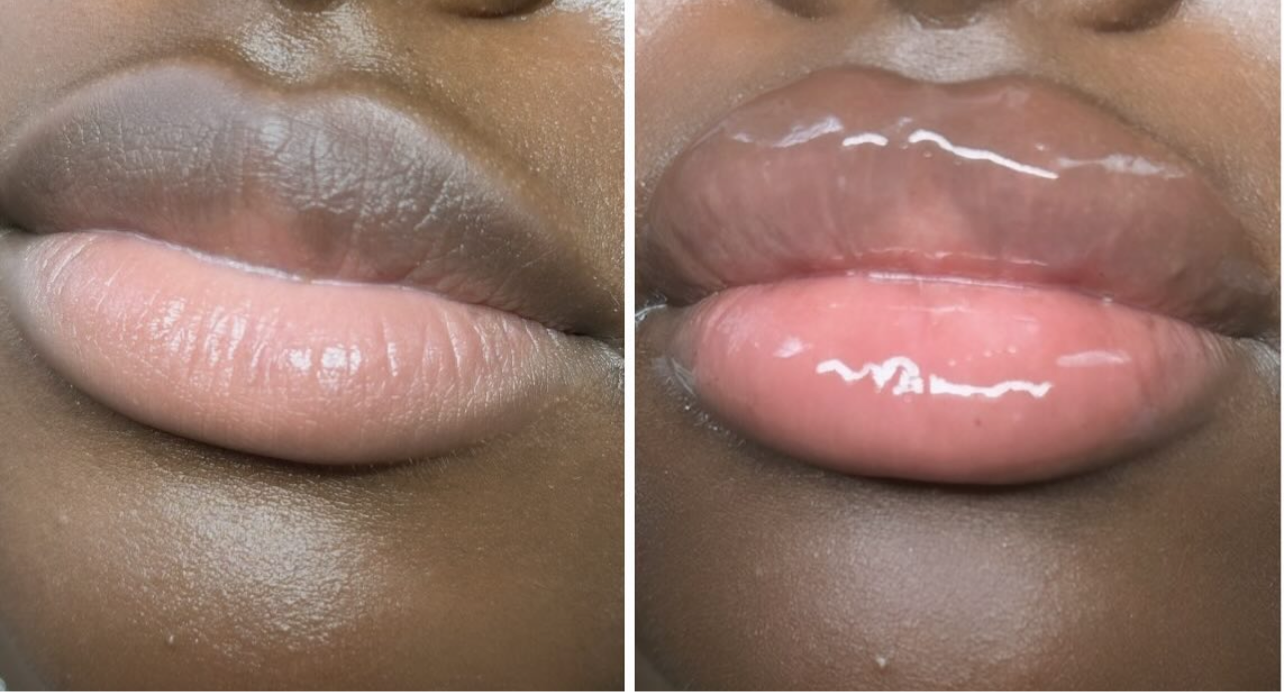 Plumping Lip filler